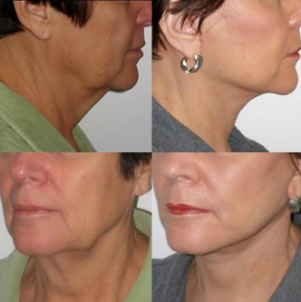 ABG Αντιγραφή