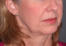 lower facelift photos 2